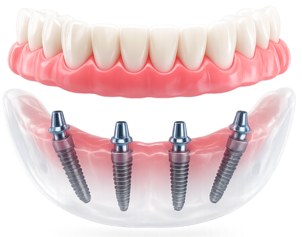Протез All-on-4